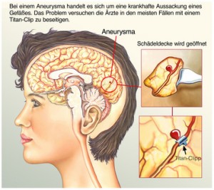 Aneurysma Gehirn Was ist ein Aneurysma?