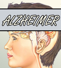 Alzheimer Ursachen und Symptome